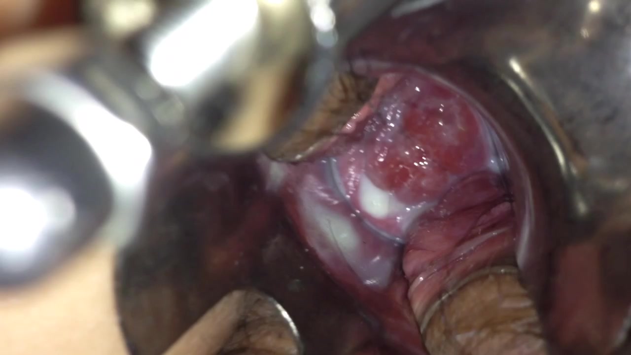 高清温度计插子宫口